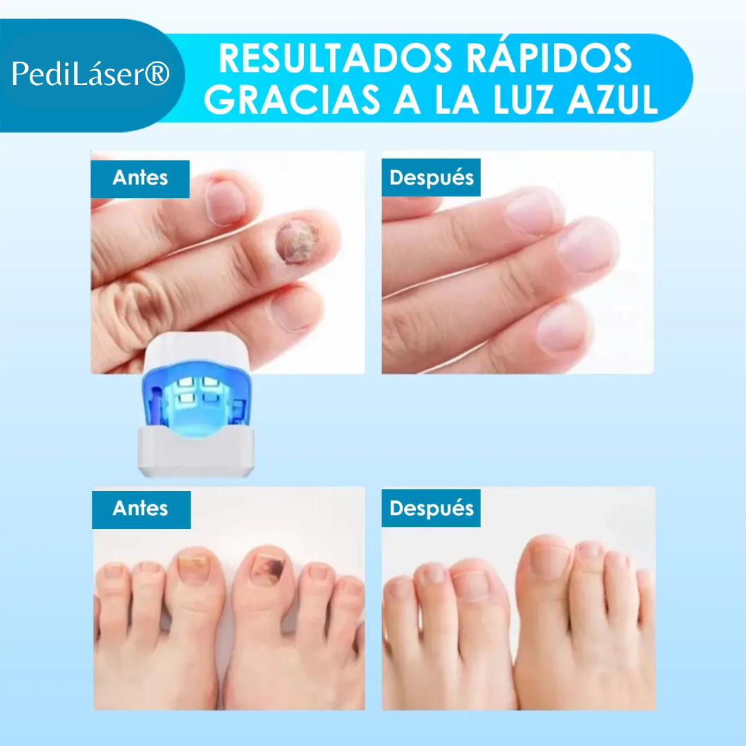 PediLáser® - Láser para Uñas